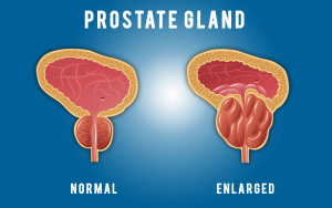 what is the main cause of prostate problems